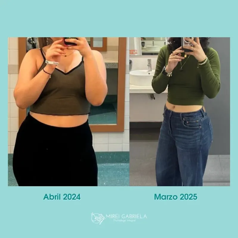 Antes y después de una paciente de Mirei